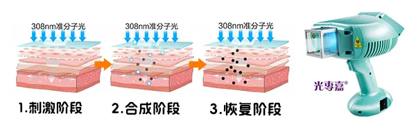 308准分子光疗仪作用机制.png