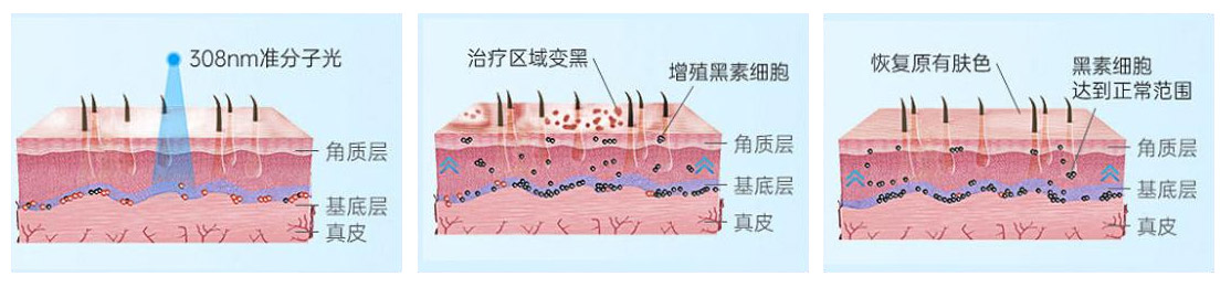 光疗原理 (2).jpg